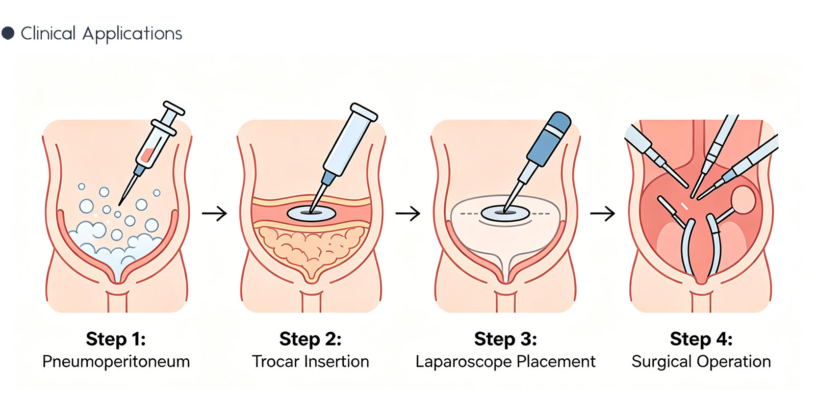 Medical Laparoscopic Instrument Trocar Suite