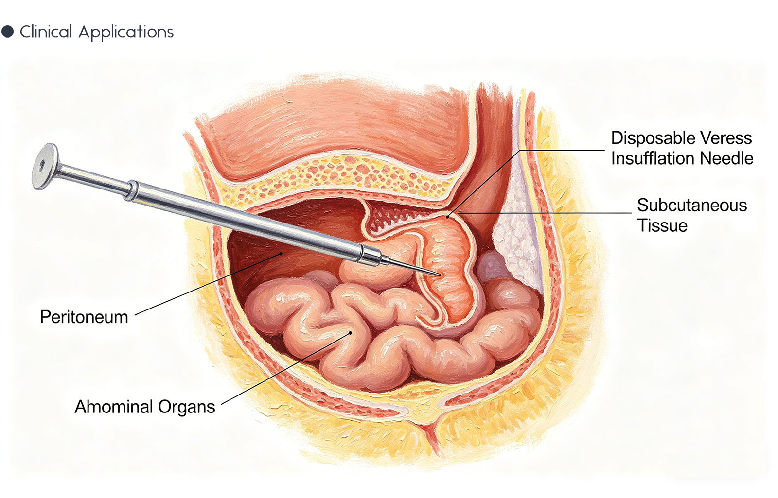 Disposable Veress Insufflation Needle