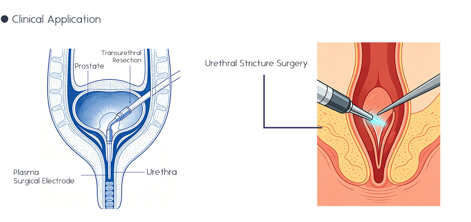 Disposable Plasma Surgical Electrode