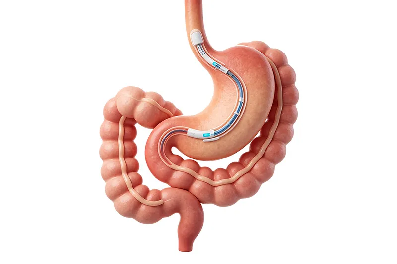 Gastric bypass surgery procedure using minimally invasive bariatric techniques